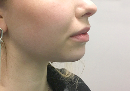 An After Photo of Chin Filler in Bellevue and Kirkland