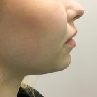 An After Photo of Chin Filler in Bellevue and Kirkland