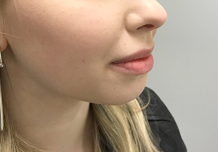 A Before Photo of Chin Filler in Bellevue and Kirkland
