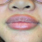 An After Photo of Restylane Kysse Lip Filler in Bellevue and Kirkland