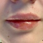 An After Photo of Restylane Defyne Lip Filler In Bellevue & Kirkland