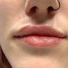 An After Photo of Restylane Refyne Lip Filler In Bellevue and Kirkland