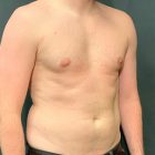 An After Photo of Gynecomastia Plastic Surgery In Seattle and Tacoma