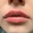 An After Photo of Lip Filler Injections in Bellevue and Kirkland