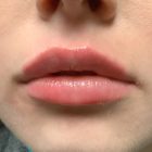 An After Photo of Lip Filler Injections in Bellevue and Kirkland