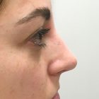 An After Photo of a Non-Surgical Rhinoplasty in Bellevue and Kirkland