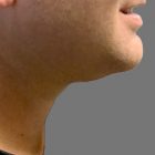 An After Photo of Kybella Injections In Bellevue and Kirkland