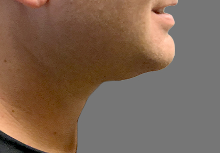 An After Photo of Kybella Injections In Bellevue and Kirkland