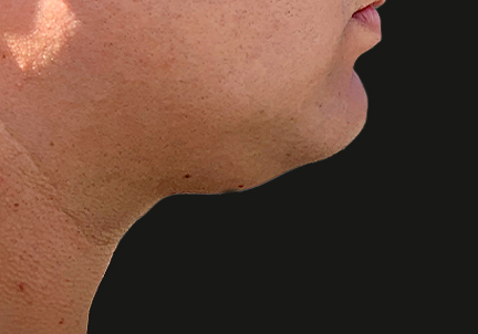 A Before Photo of Kybella Injections In Bellevue and Kirkland