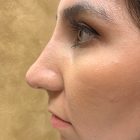 An After Photo For A Non-Surgical Rhinoplasty In Bellevue and Kirkland