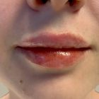 An After Photo of Restylane Defyne Lip Filler In Bellevue and Kirkland