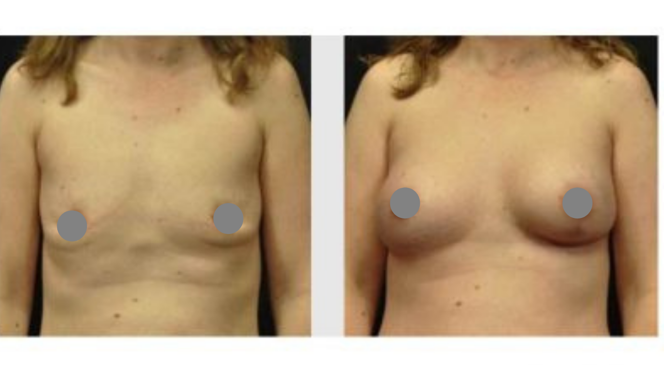 A Censored Before & After Photo Of A Breast Augmentation Plastic Surgery by Dr. Craig Jonov in Bellevue and Kirkland