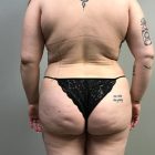 An After Photo Of A Brazilian Butt Lift by Dr. Craig Jonov In Bellevue and Kirkland