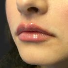 An After Photo of Restylane Defyne Lip Filler In Bellevue and Kirkland