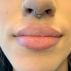 An After Photo of Restylane Kysse Lip Filler In Bellevue and Kirkland