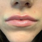 An After Photo of Juvederm Ultra Plus Lip Filler In Bellevue and Kirkland