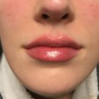 An After Photo of Juvederm Ultra Lip Filler In Bellevue and Kirkland