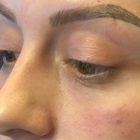 An After Photo of Under Eye Filler In Bellevue and Kirkland