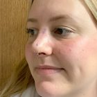 An After Photo of Rhinoplasty Plastic Surgery by Dr. Craig Jonov in Bellevue and Kirkland