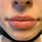 An After Photo of Restylane Kysse Lip Filler In Bellevue and Kirkland