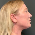 An After Photo of a Facelift Plastic Surgery by Dr. Craig Jonov in Bellevue and Kirkland