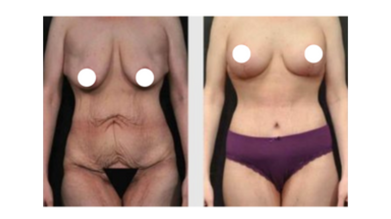 A Before & After Photo of a Tummy Tuck with Thigh Lift Plastic Surgery by Dr. Craig Jonov in Bellevue and Kirkland