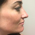 An After Photo of a Non-Surgical Rhinoplasty In Bellevue & Kirkland