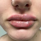 An After Photo of Restylane Kysse Lip Filler In Bellevue and Kirkland