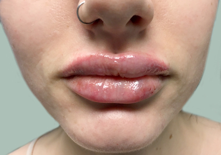 An After Photo of Restylane Kysse Lip Filler In Bellevue and Kirkland
