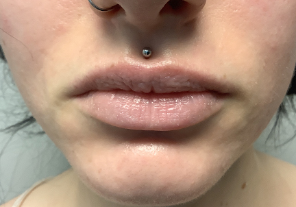 A Before Photo of Restylane Kysse Lip Filler In Bellevue and Kirkland