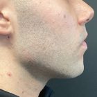 An After Photo of Jaw Filler in Bellevue and Kirkland