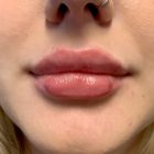 An After Photo of Lip Filler In Bellevue and Kirkland