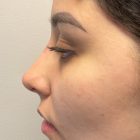 An After Photo of a Non-Surgical Rhinoplasty in Bellevue and Kirkland