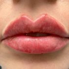 An After Photo of Restylane Kysse Lip Filler in Bellevue and Kirkland