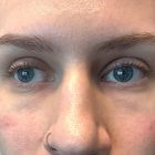 An After Photo of Under Eye Fillers In Bellevue and Kirkland