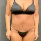 An After Photo of Fleur-de-lis Tummy Tuck Plastic Surgery by Dr. Craig Jonov in Bellevue and Kirkland