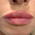 An After Photo of Restylane Kysse Lip Filler in Bellevue and Kirkland