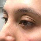 An After Photo of Under Eye Fillers in Bellevue and Kirkland