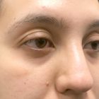 A Before Photo of Under Eye Fillers in Bellevue and Kirkland