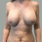An After Photo of Breast Augmentation Plastic Surgery by Dr. Craig Jonov in Bellevue and Kirkland