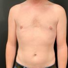 An After Photo of Gynecomastia Plastic Surgery by Dr. Craig Jonov in Bellevue and Kirkland