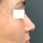 An After Photo of a Non-Surgical Rhinoplasty in Bellevue & Kirkland