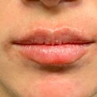 An After Photo of Restylane Kysse Lip Filler in Bellevue and Kirkland