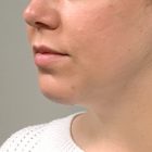 An After Photo of Chin Augmentation Plastic Surgery by Dr. Craig Jonov in Bellevue and Kirkland
