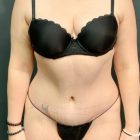 An After Photo of Tummy Tuck Plastic Surgery by Dr. Craig Jonov in Seattle and Tacoma