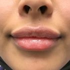 An After Photo of Restylane Lip Filler in Bellevue and Kirkland