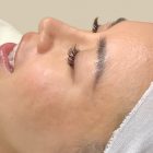 An After Photo of Microneedling in Seattle and Tacoma