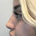 An After Photo of a Non-Surgical Rhinoplasty in Bellevue and Kirkland