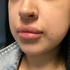 An After Photo of Restylane Kysse Lip Filler in Bellevue and Kirkland