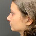 An After Photo of a Rhinoplasty Plastic Surgery by Dr. Craig Jonov in Bellevue and Kirkland